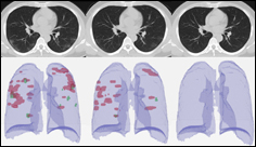 Hospitals Deploy AI Tools to Detect COVID-19 on Chest Scans