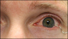 Měkké kontaktní čočky pro monitorování očních problémů